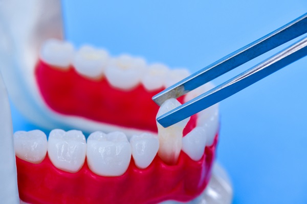 What Happens After Dental Implants Are Placed?
