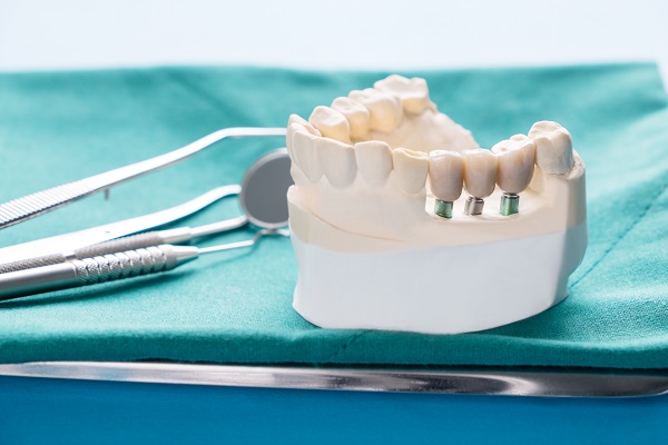 A Brief Comparison Between Implant Supported Dentures And Traditional Dentures