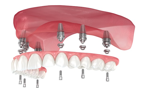 Implant Supported Dentures St. George, UT