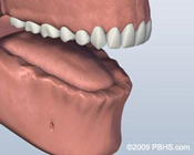 dental implants