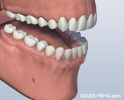 dental implants