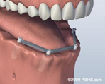 dental implants