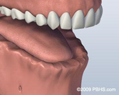 dental implants