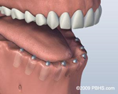 dental implants