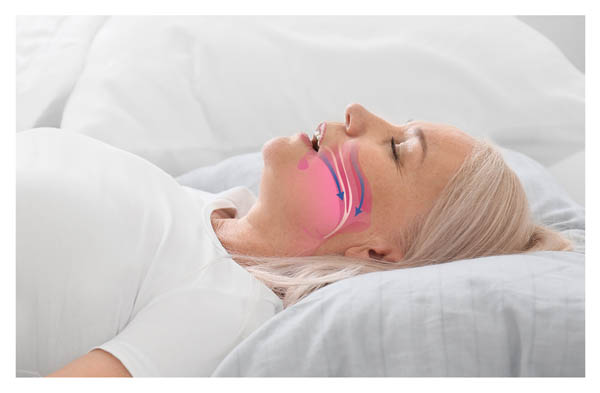How A General Dentist Treats Sleep Apnea